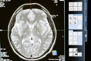 beyin mri görüntüsü