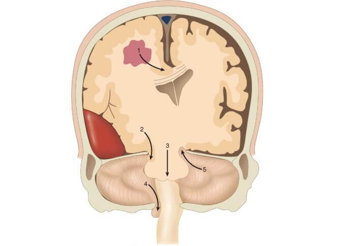 https://new.engincakar.com/wp-content/uploads/2024/07/tumor.jpg